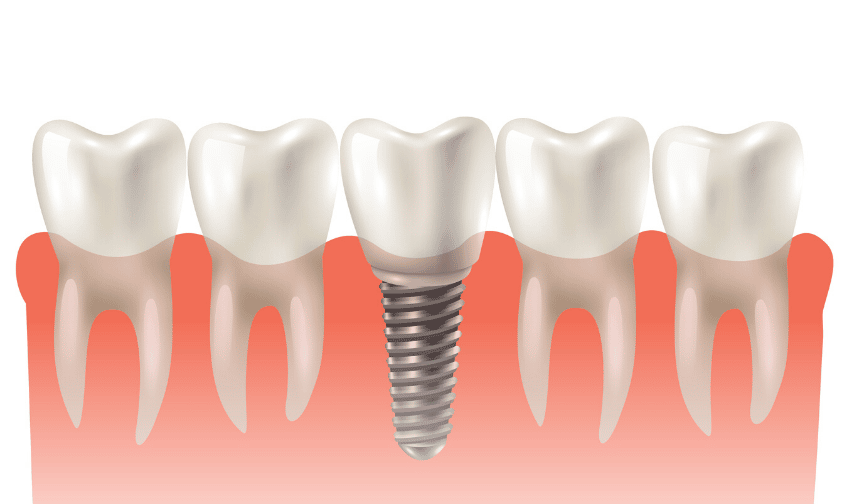 dental implants