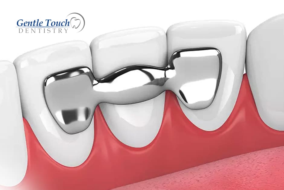 Dental Bridges