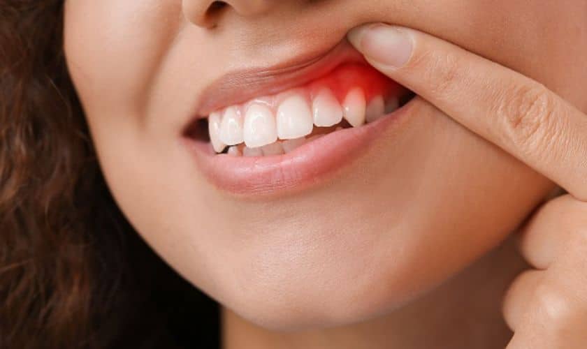Periodontitis-Treatment