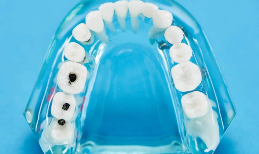 Full Arch Dental Implants